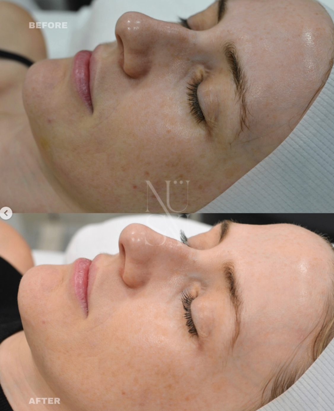 Client skin result 4, before and after treatment