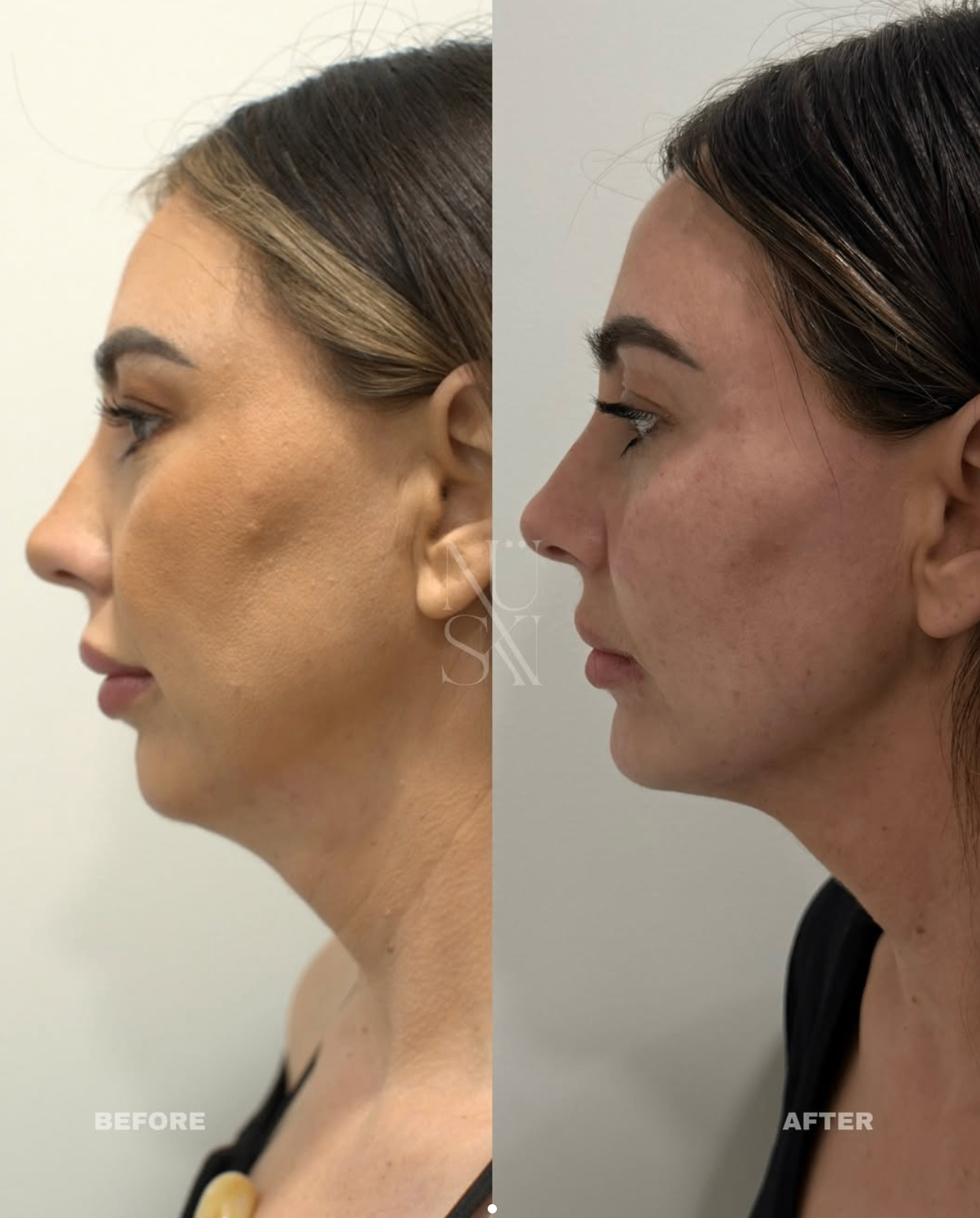 Client skin result 8, before and after treatment