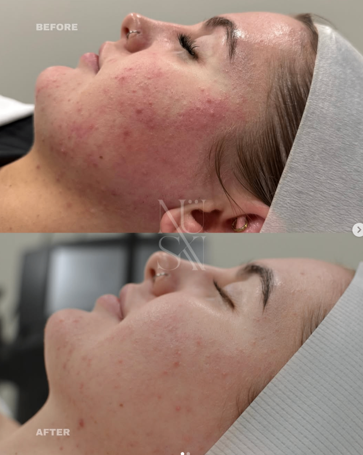 Client skin result 10, before and after treatment