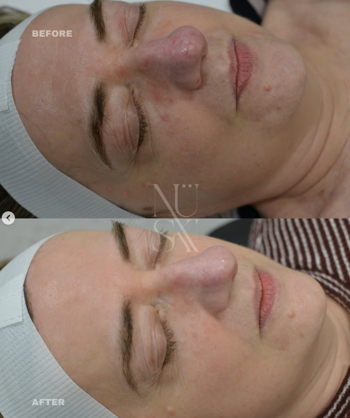 Client skin result 1, before and after treatment