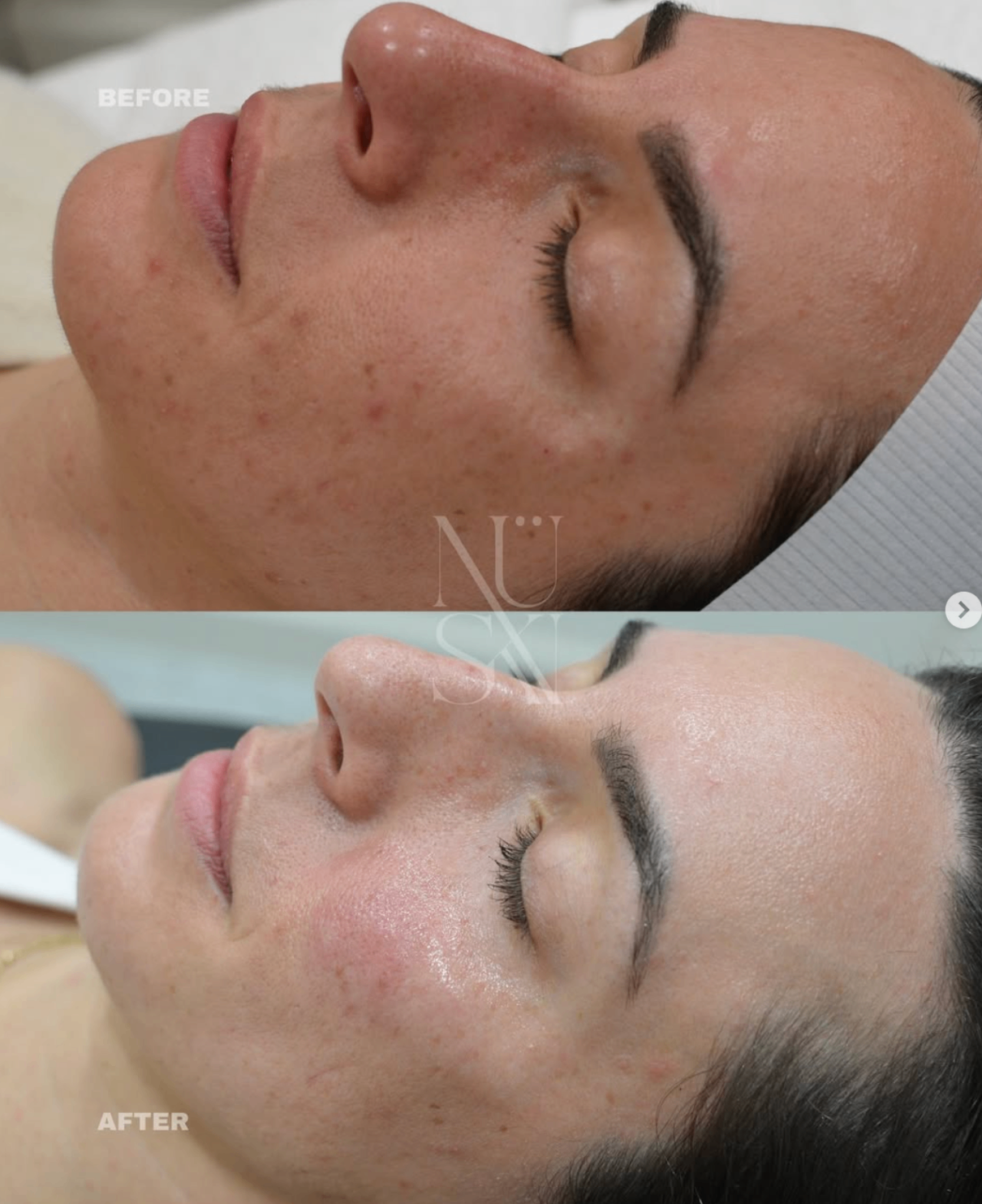 Client skin result 7, before and after treatment