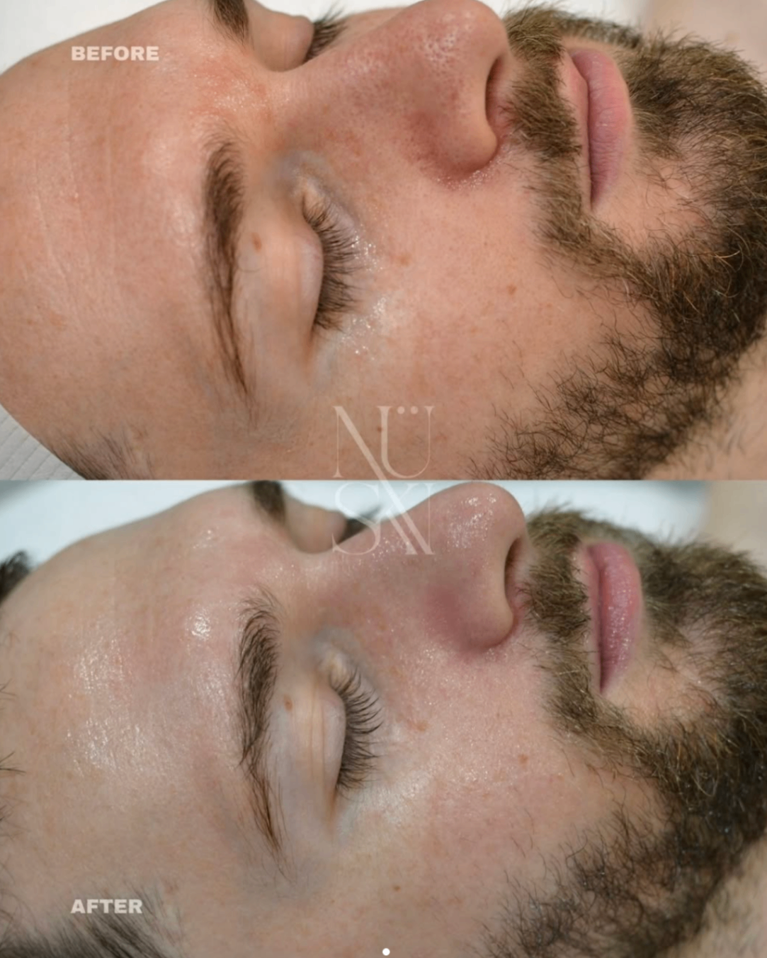 Client skin result 9, before and after treatment