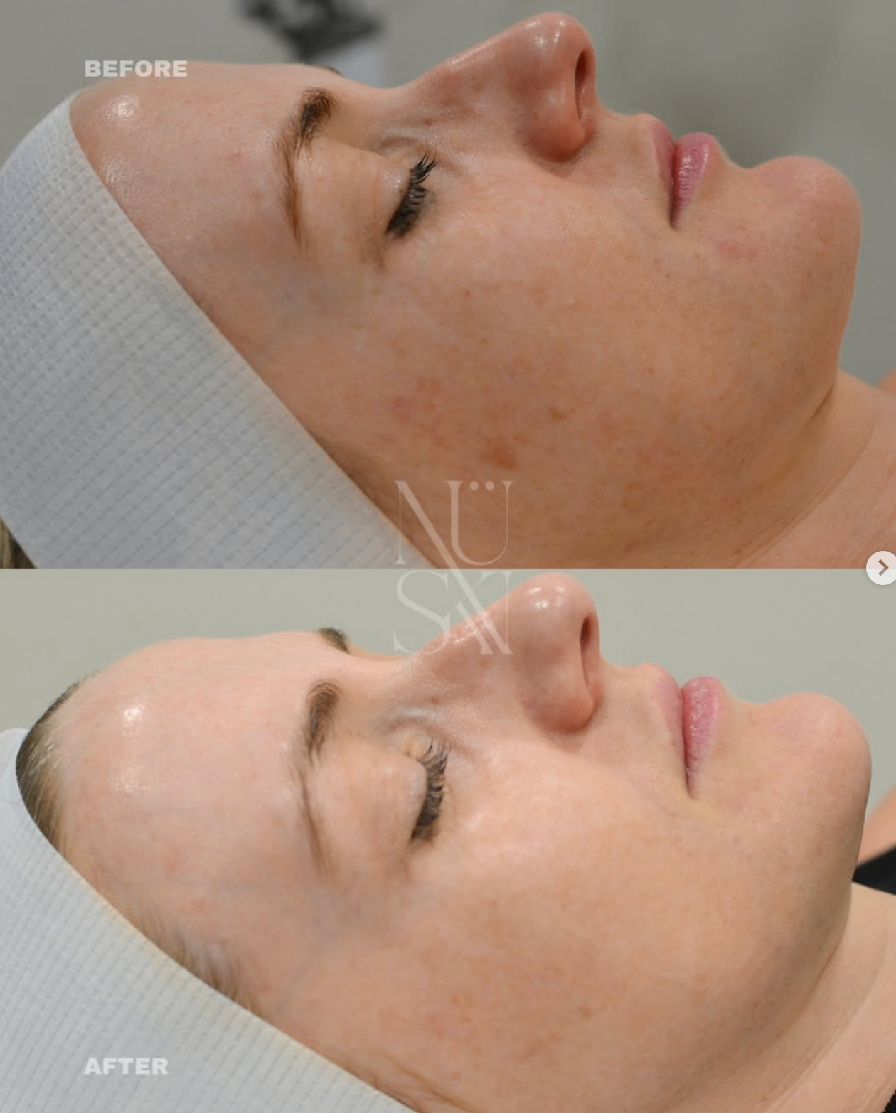 Client skin result 3, before and after treatment