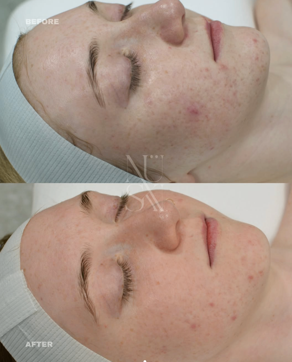 Client skin result 6, before and after treatment