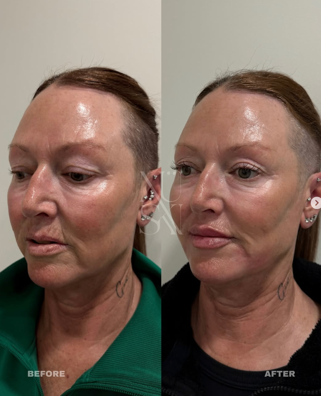 Client skin result 5, before and after treatment