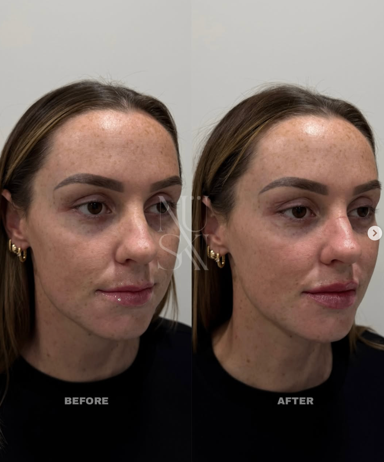 Client skin result 2, before and after treatment